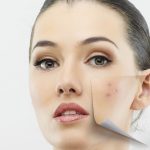 چگونه پوستی بدون لک داشته باشیم