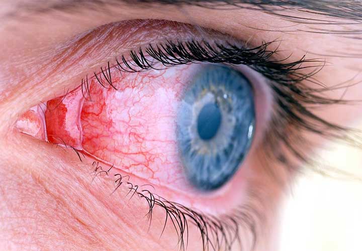 اثر بیماری کرون روی چشم- درمان التهاب روده
