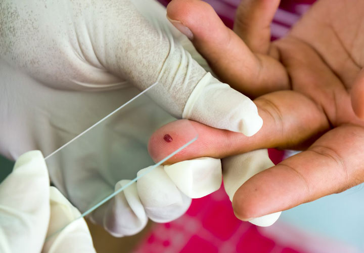 مالاریا ؛ علل نشانه ها و درمان - آزمایش خون