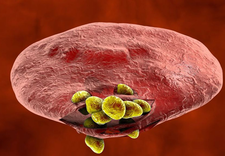 مالاریا ؛ علل نشانه ها و درمان - تخریب گلبول های قرمز خون