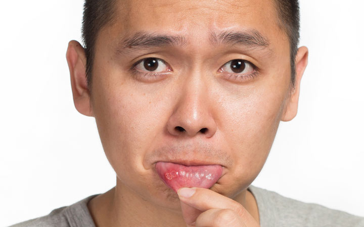 آفت دهان معمولا زخمی گرد یا بیضی شکل سفید یا زرد رنگ است که دور تا دور آن قرمز شده باشد ـ درمان آفت دهان