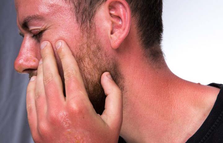 درمان آفتاب سوختگی با جدا نکردن پوسته ها