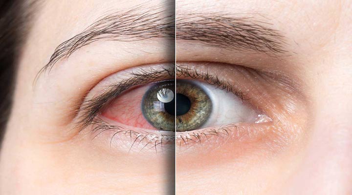 حساسیت چشم به نور به دلیل سندرم خشکی چشم