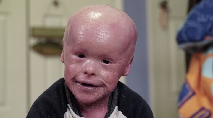 کودکی مبتلا به بیماری ایکتیوز که پوست صورتش خشک، کشیده و صورتی‌رنگ است