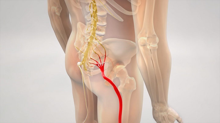 Exercise for sciatica pain - What is sciatica?