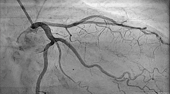 Coronary artery occlusion angiography