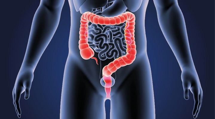 Colon Cancer