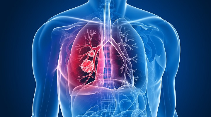 Lung cancer