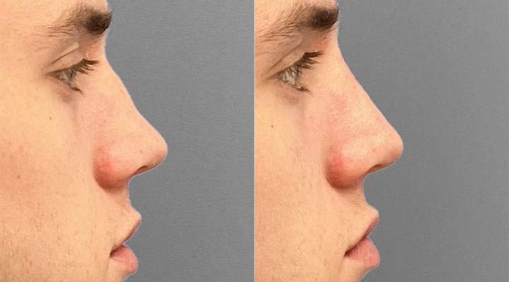 Rhinoplasty without surgery - Benefits of rhinoplasty without surgery