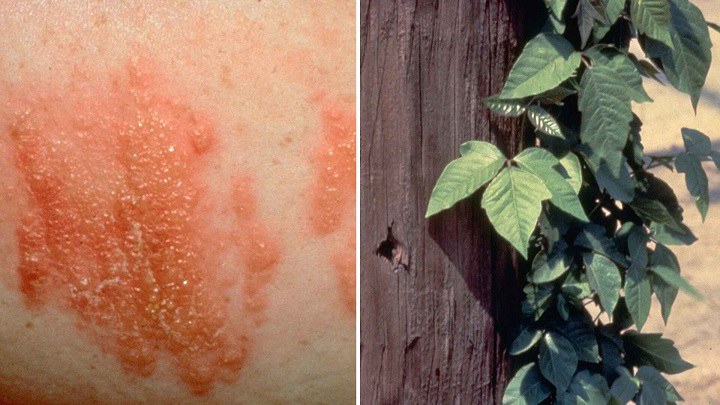 Skin rash caused by contact with poison ivy