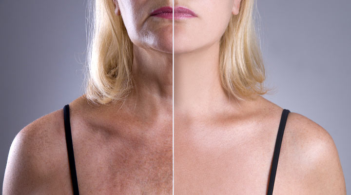 تفاوت پوست شفاف و پوست آسیب‌دیده در ناحیه دکلته